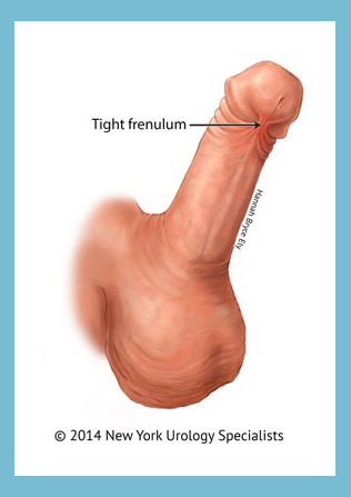 Penis frenectomy near me Southeast NSW